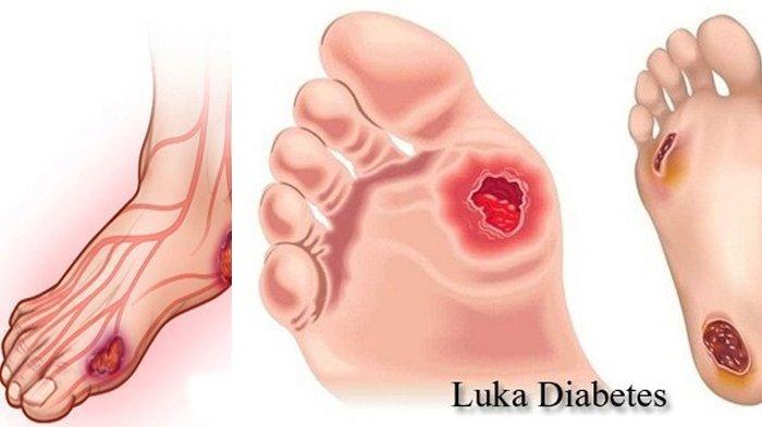 Cara Merawat Luka Diabetes Agar Tidak Menjadi Berbahaya